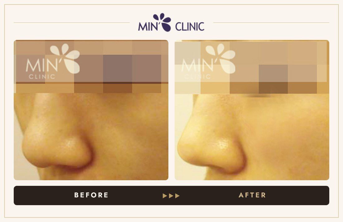 Nose filler before and after, case 1 – MIN Clinic Seoul