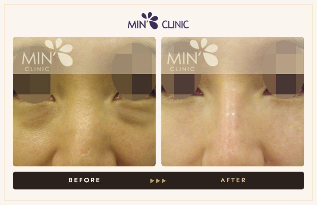 Nose filler before and after, case 2 – MIN Clinic Seoul