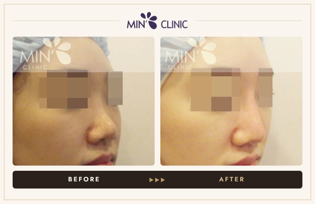 Nose filler before and after, case 3 – MIN Clinic Seoul