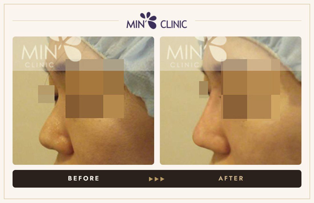 Nose filler before and after, case 4 – MIN Clinic Seoul
