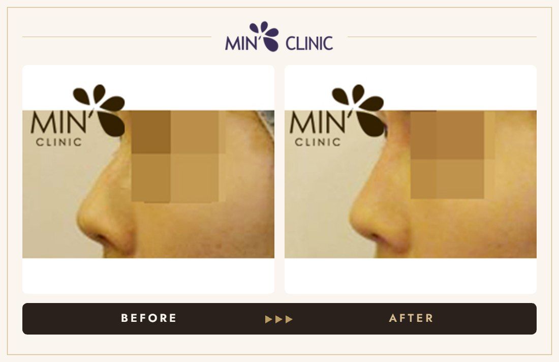 Nose filler before and after, case 5 – MIN Clinic Seoul