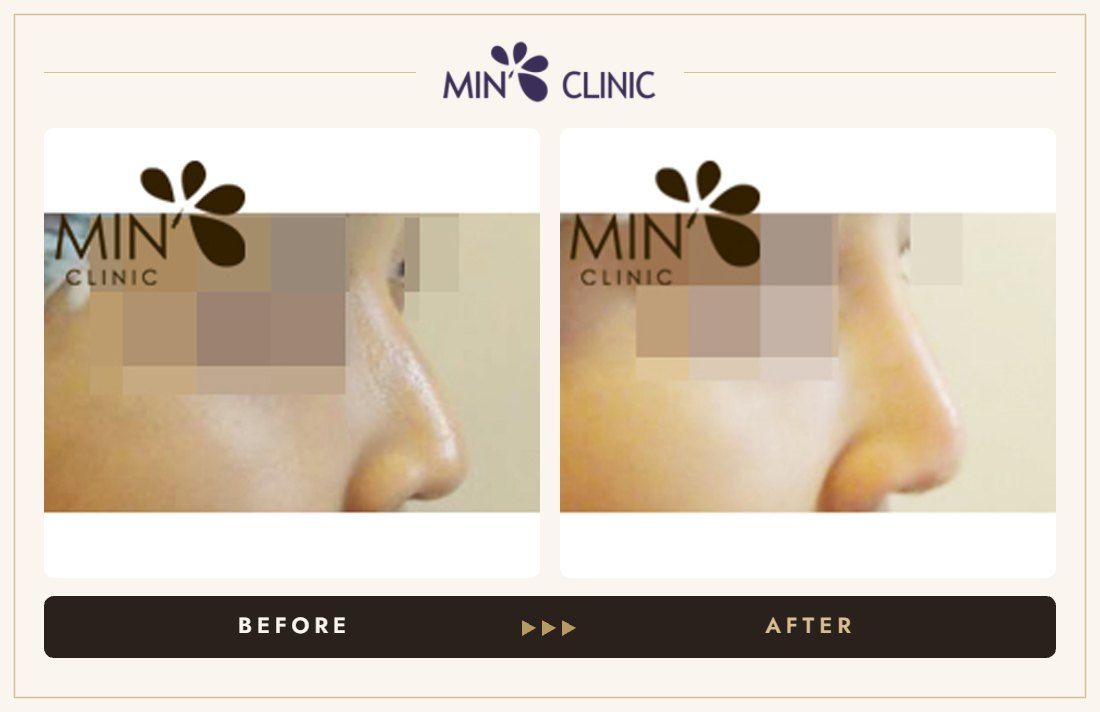 Nose filler before and after, case 6 – MIN Clinic Seoul