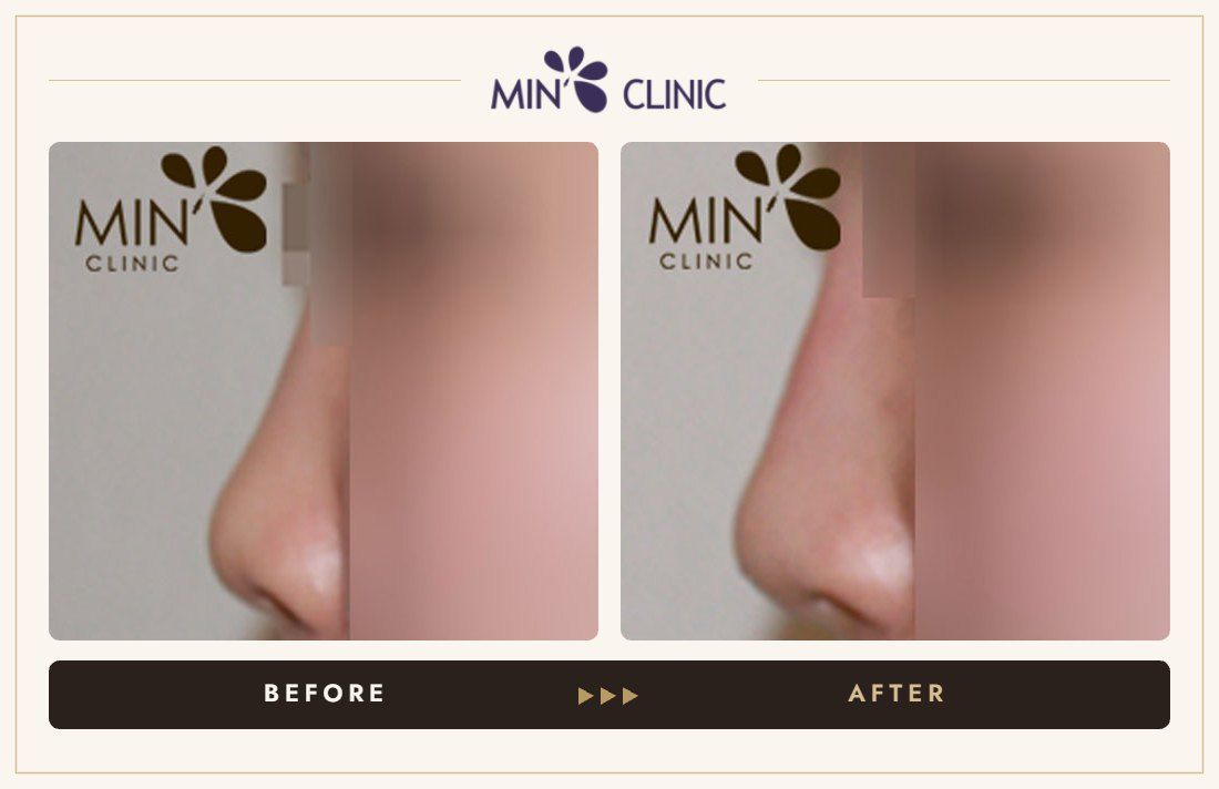 Nose filler before and after, case 7 – MIN Clinic Seoul