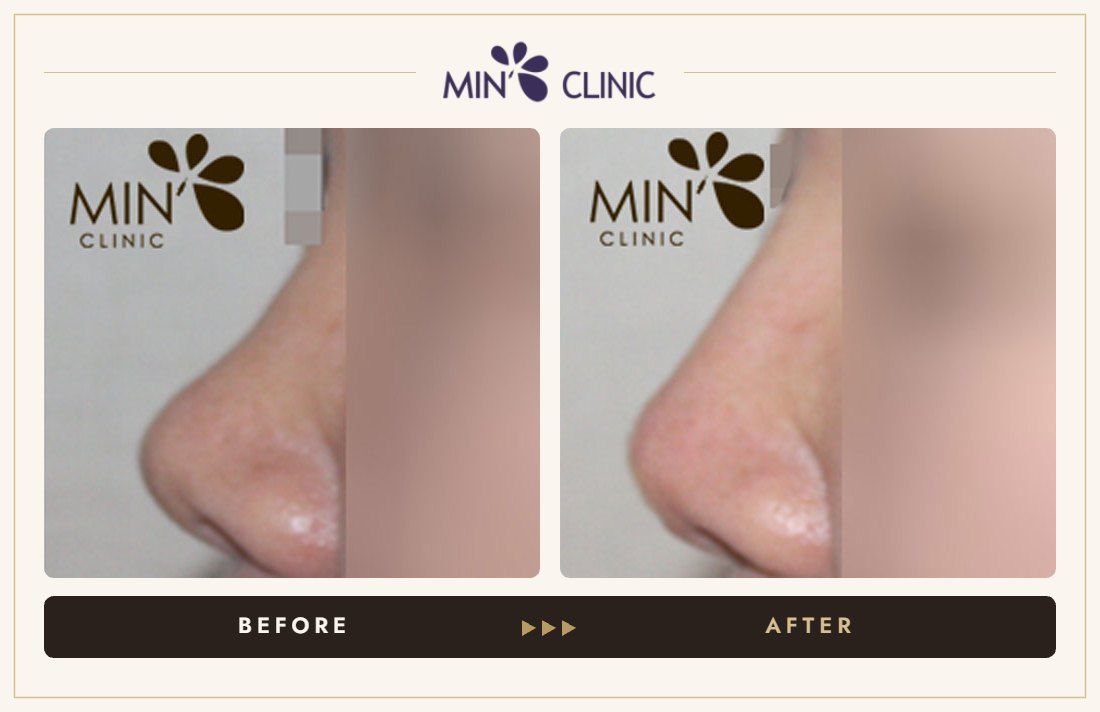 Nose filler before and after, case 8 – MIN Clinic Seoul