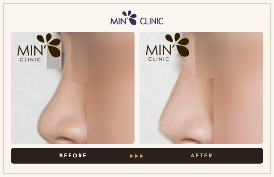 Nose filler before and after, case 9 – MIN Clinic Seoul