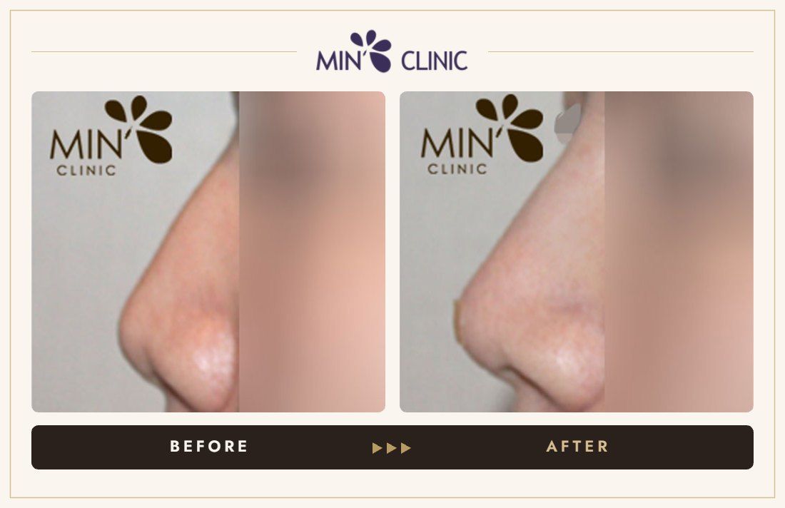 Nose filler before and after, case 10 – MIN Clinic Seoul