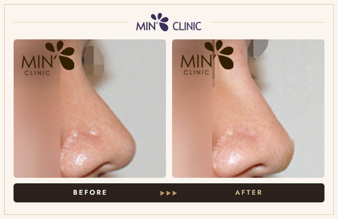 Nose filler before and after, case 11 – MIN Clinic Seoul