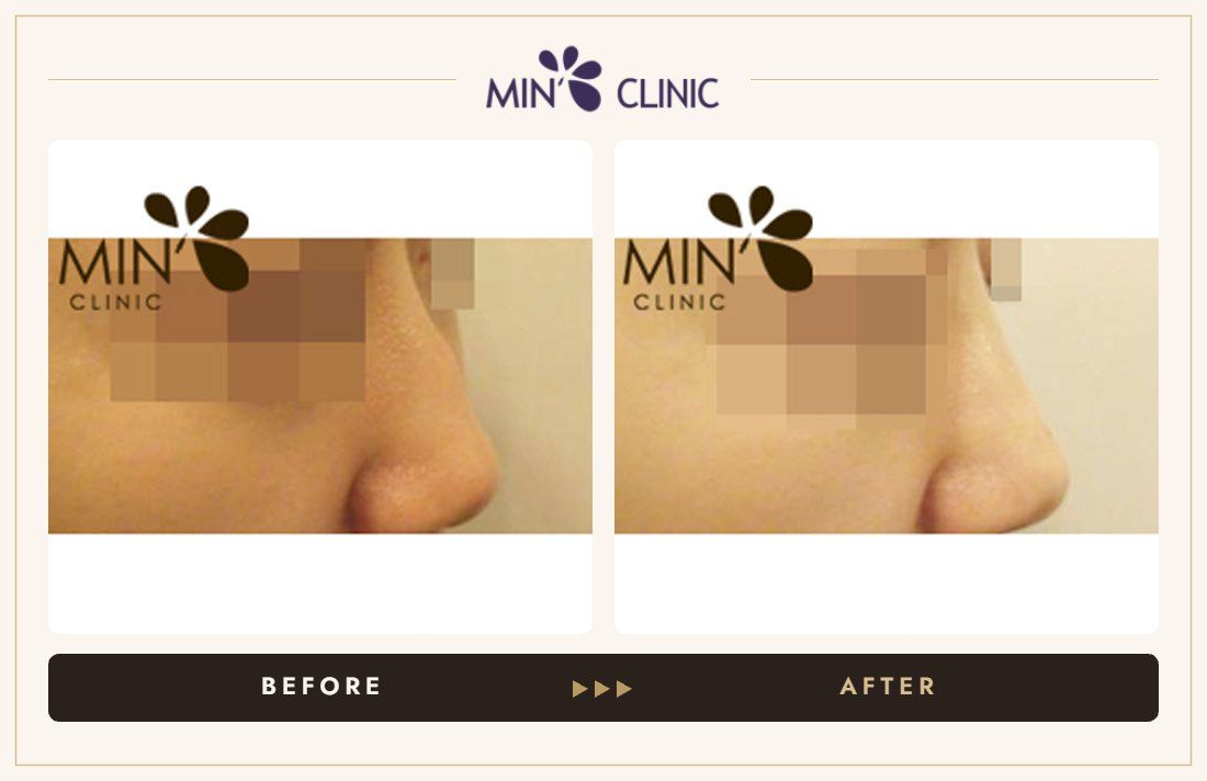 Nose filler before and after, case 12 – MIN Clinic Seoul
