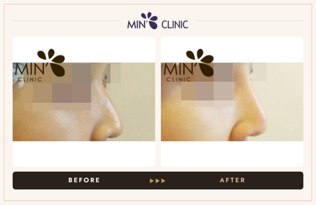 Nose filler before and after, case 13 – MIN Clinic Seoul