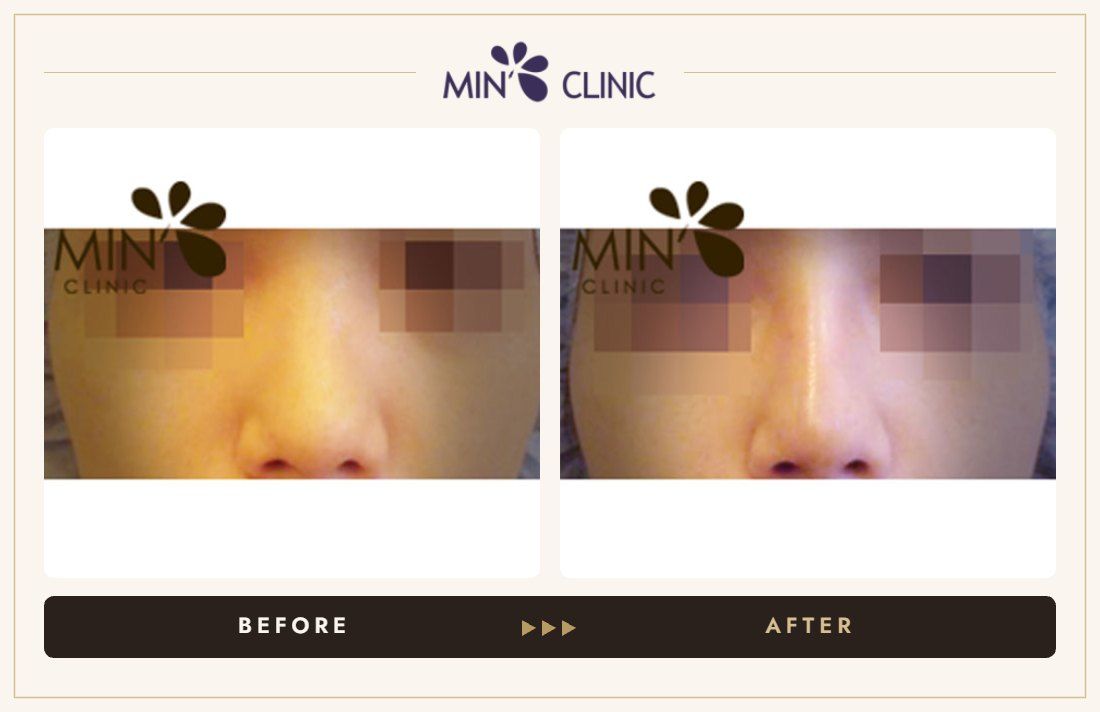 Nose filler before and after, case 14 – MIN Clinic Seoul