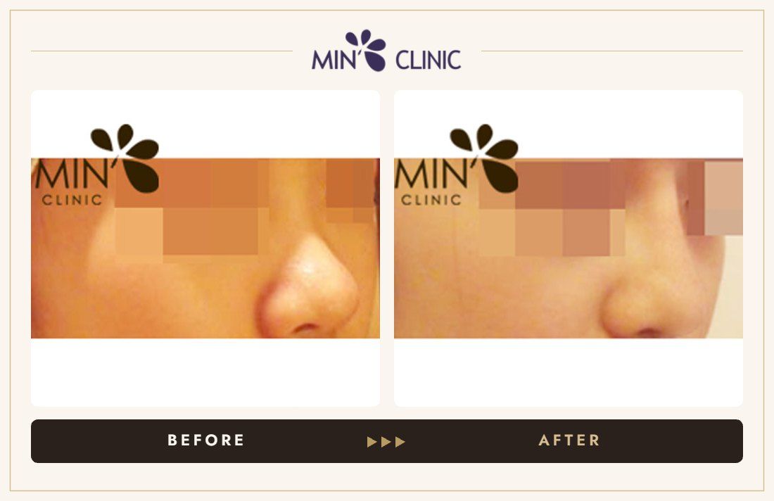 Nose filler before and after, case 15 – MIN Clinic Seoul