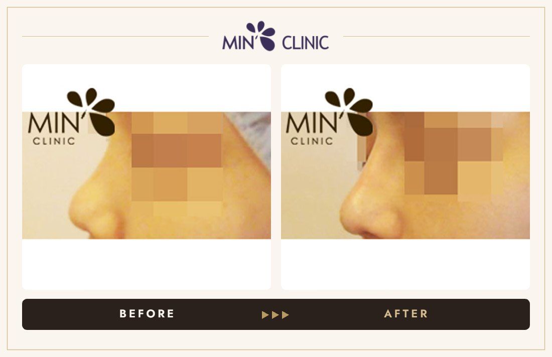 Nose filler before and after, case 16 – MIN Clinic Seoul