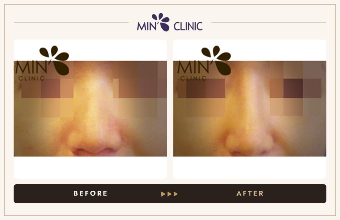 Nose filler before and after, case 17 – MIN Clinic Seoul