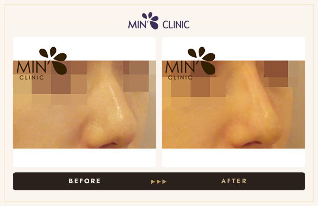 Nose filler before and after, case 18 – MIN Clinic Seoul