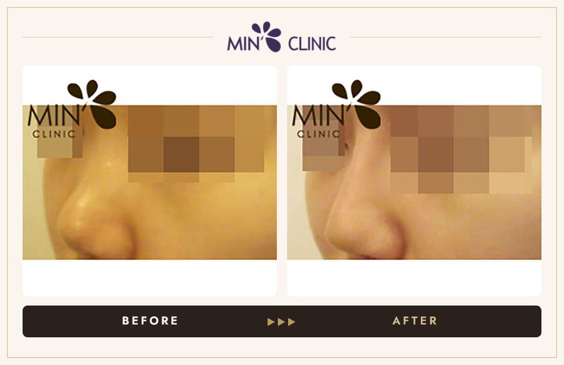 Nose filler before and after, case 19 – MIN Clinic Seoul