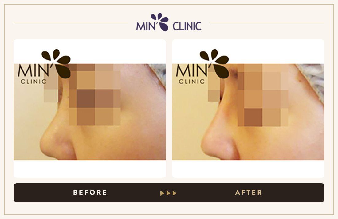 Nose filler before and after, case 20 – MIN Clinic Seoul