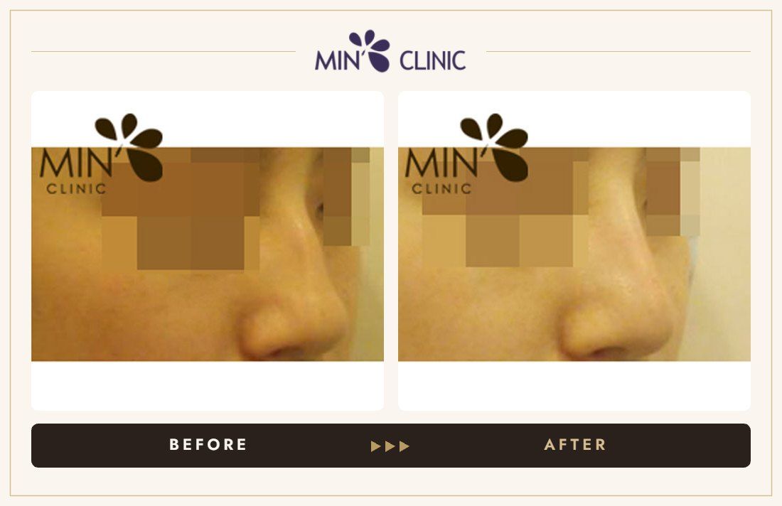 Nose filler before and after, case 21 – MIN Clinic Seoul