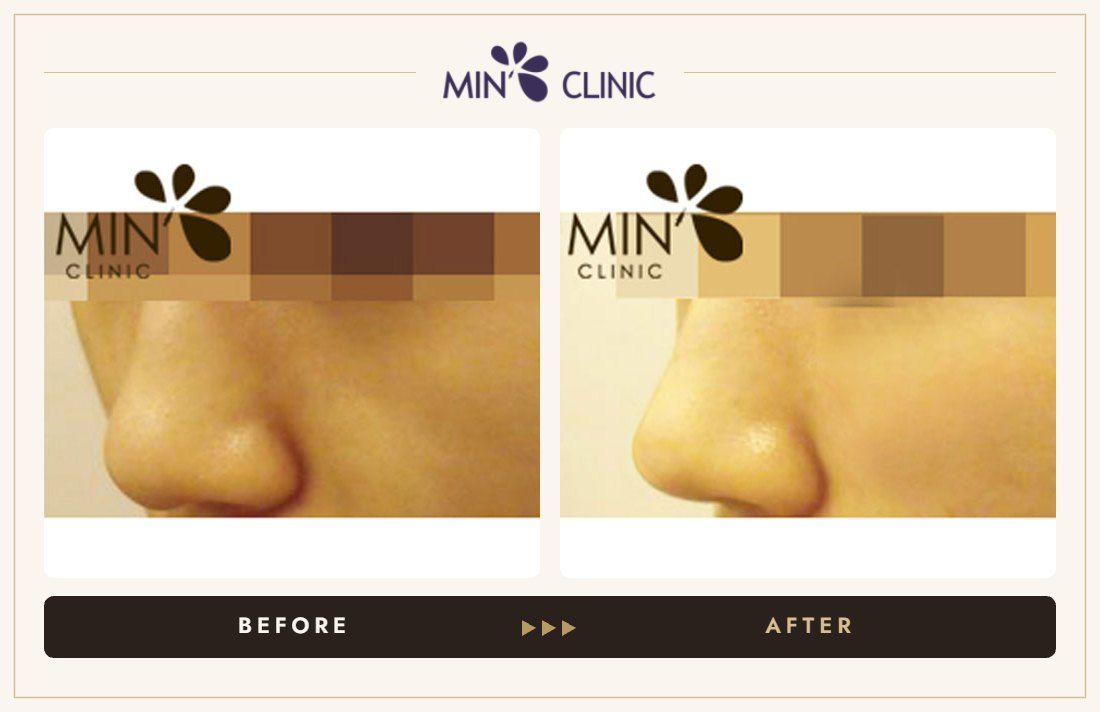 Nose filler before and after, case 22 – MIN Clinic Seoul