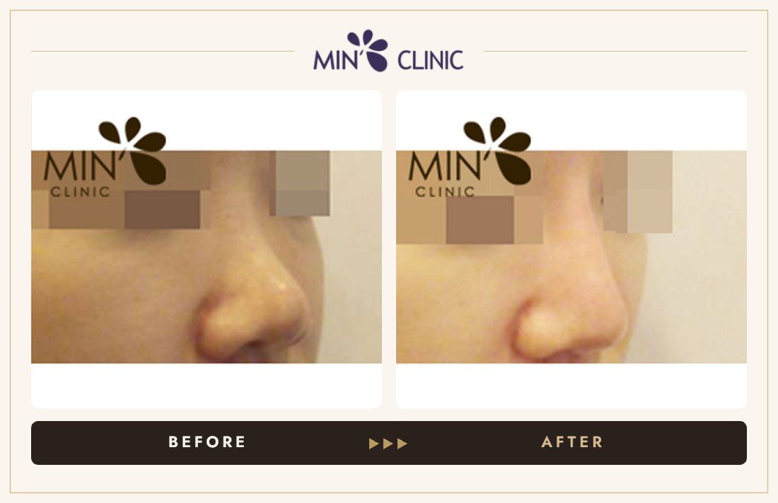 Nose filler before and after, case 23 – MIN Clinic Seoul