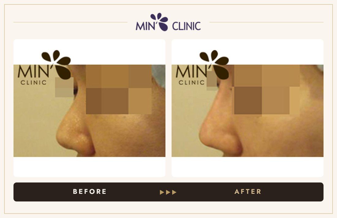 Nose filler before and after, case 24 – MIN Clinic Seoul