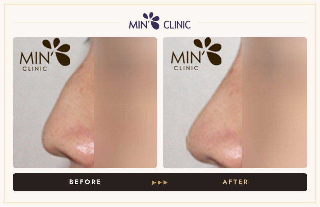 Nose filler before and after, case 25 – MIN Clinic Seoul