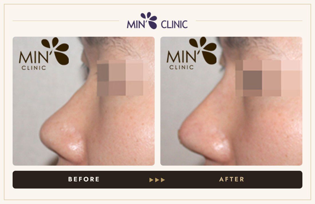 Nose filler before and after, case 27 – MIN Clinic Seoul