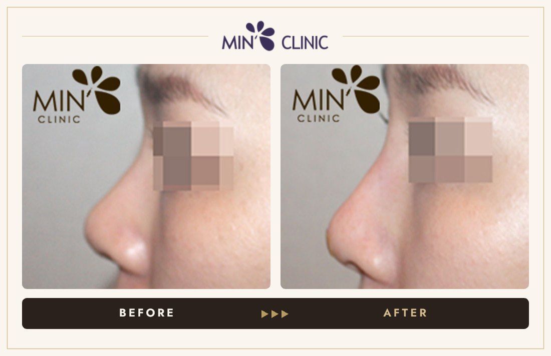Nose filler before and after, case 28 – MIN Clinic Seoul