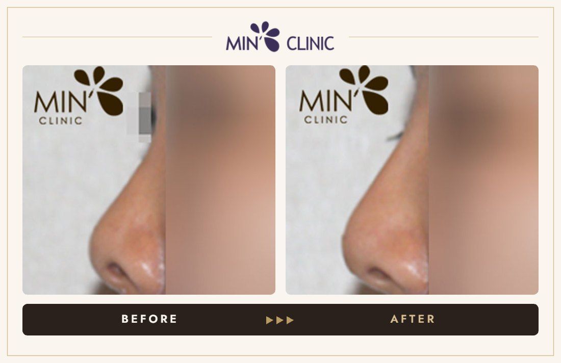 Nose filler before and after, case 29 – MIN Clinic Seoul