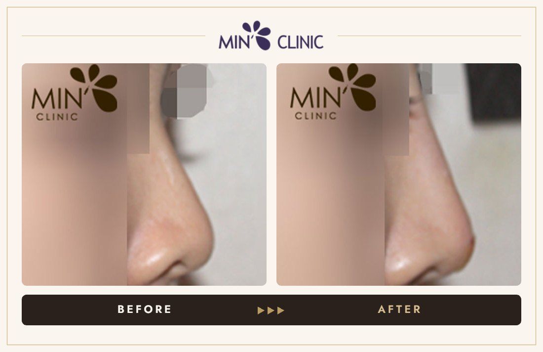 Nose filler before and after, case 30 – MIN Clinic Seoul