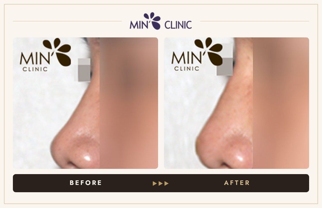 Nose filler before and after, case 31 – MIN Clinic Seoul