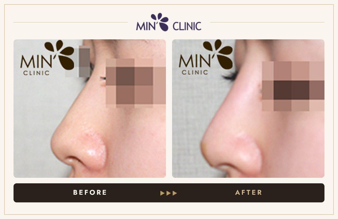 Nose filler before and after, case 32 – MIN Clinic Seoul