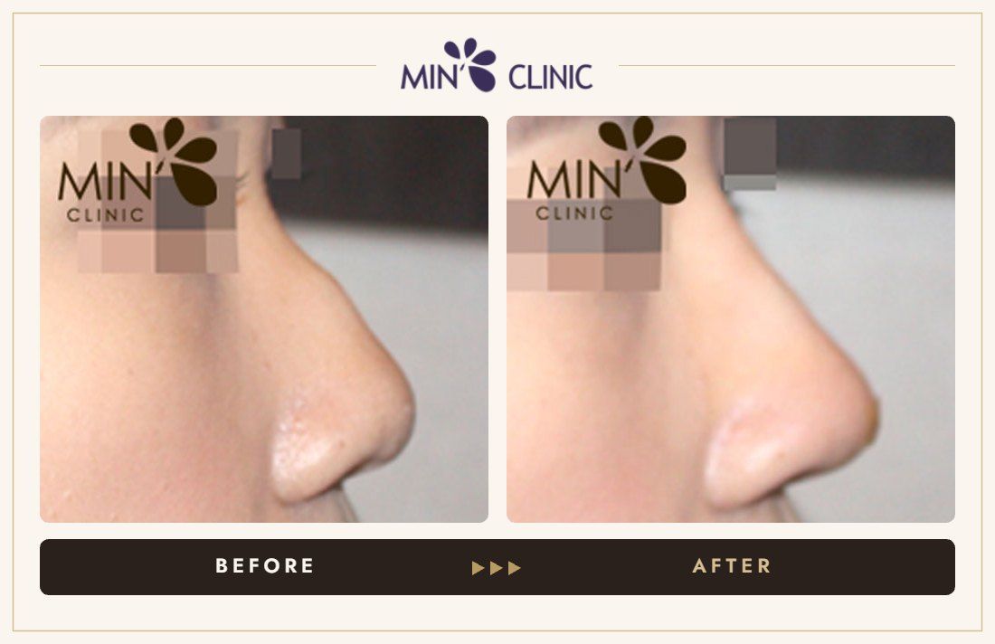 Nose filler before and after, case 33 – MIN Clinic Seoul