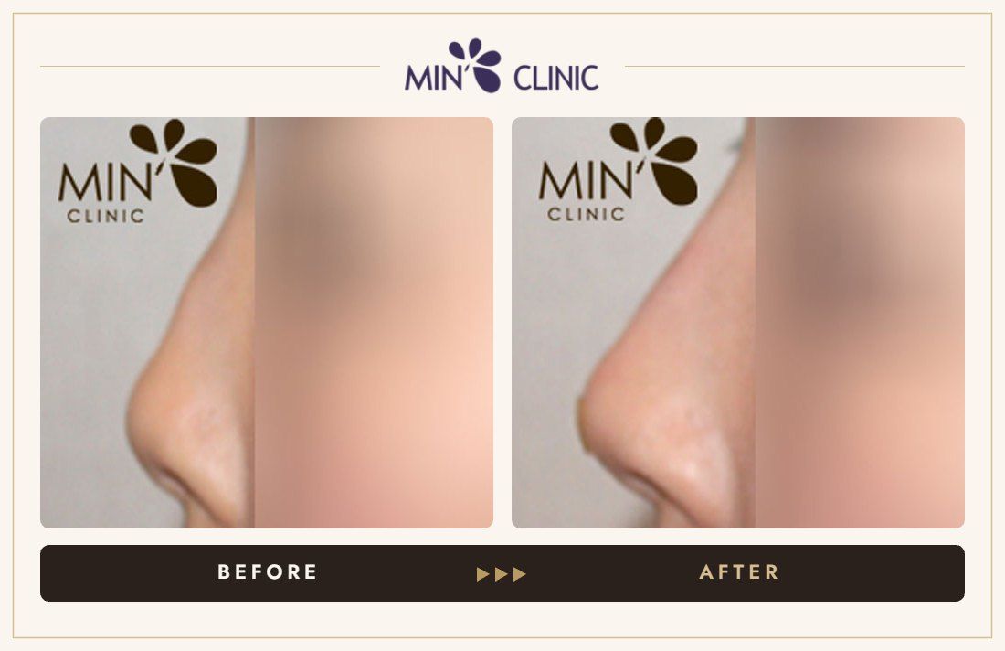Nose filler before and after, case 34 – MIN Clinic Seoul