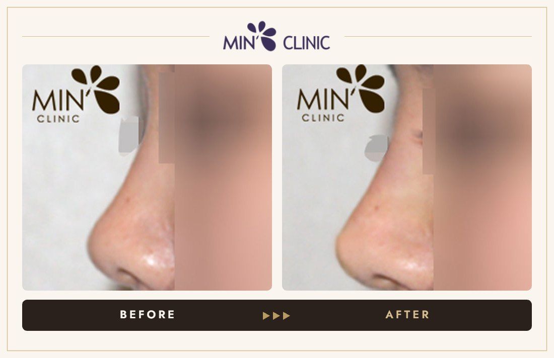 Nose filler before and after, case 35 – MIN Clinic Seoul