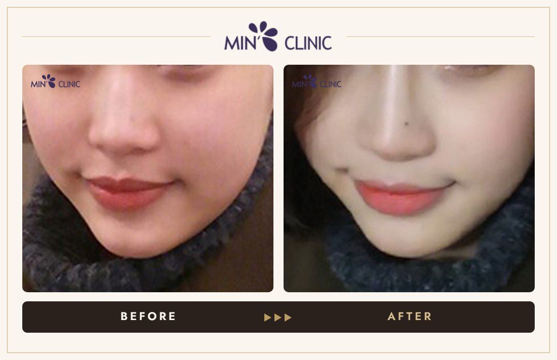 Nose filler before and after, case 36 – MIN Clinic Seoul
