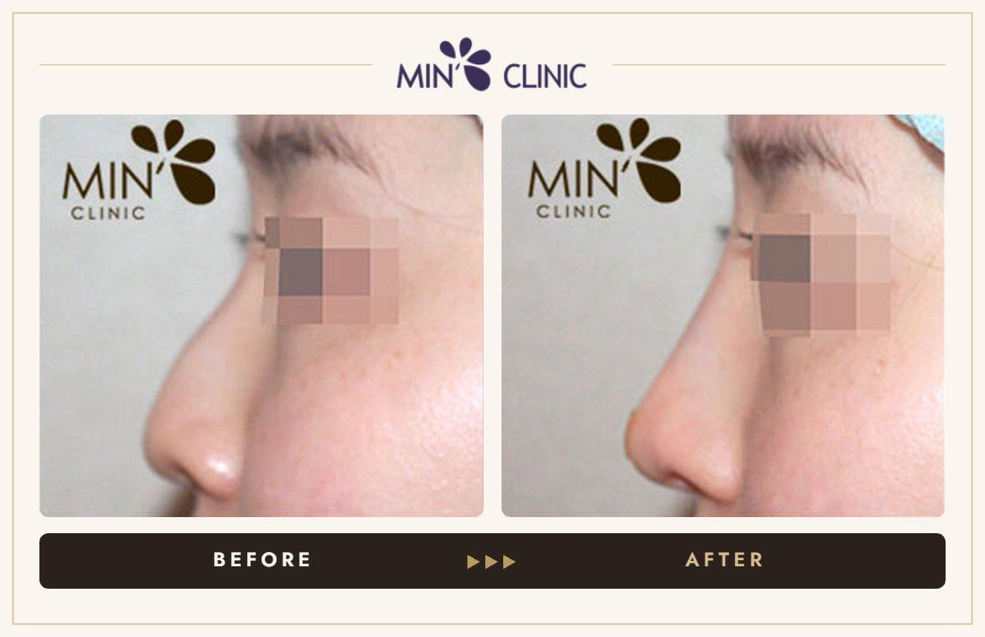 Nose filler before and after, case 37 – MIN Clinic Seoul