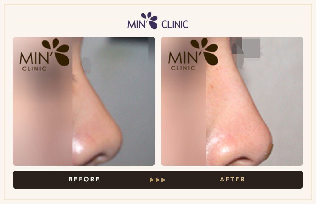 Nose filler before and after, case 38 – MIN Clinic Seoul