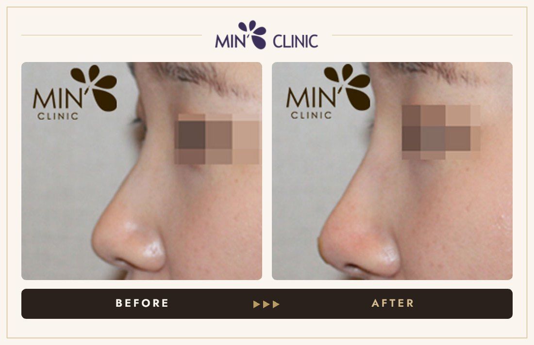Nose filler before and after, case 39 – MIN Clinic Seoul