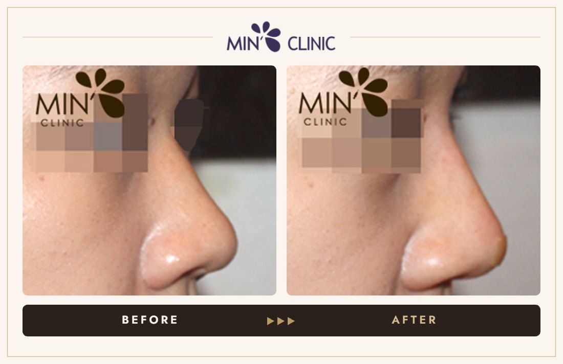 Nose filler before and after, case 40 – MIN Clinic Seoul