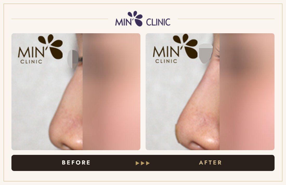 Nose filler before and after, case 41 – MIN Clinic Seoul