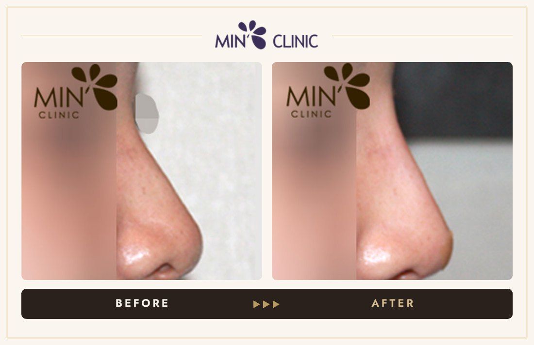 Nose filler before and after, case 42 – MIN Clinic Seoul