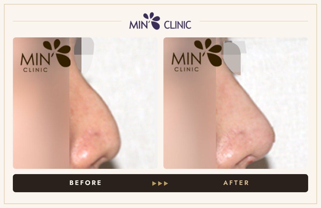 Nose filler before and after, case 43 – MIN Clinic Seoul