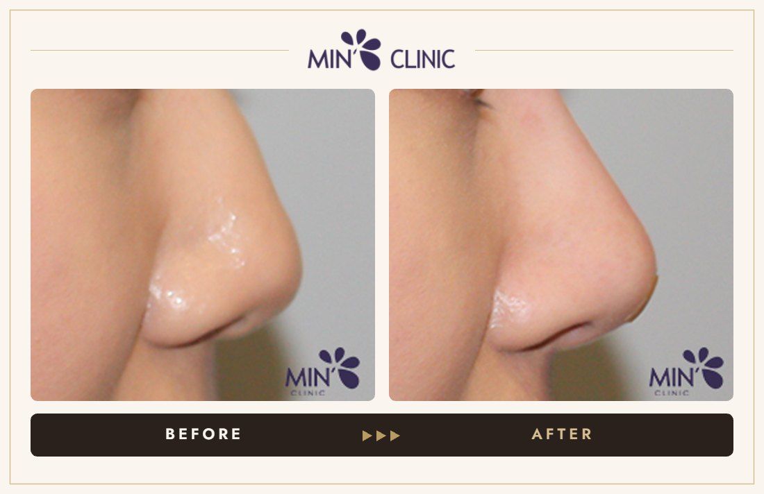 Nose filler before and after, case 44 – MIN Clinic Seoul