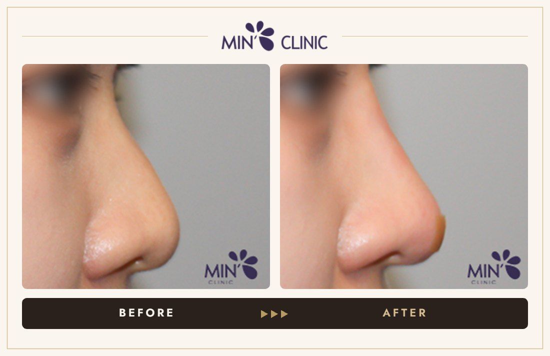 Nose filler before and after, case 45 – MIN Clinic Seoul