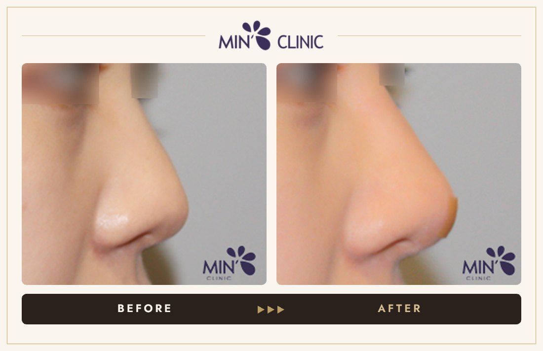 Nose filler before and after, case 46 – MIN Clinic Seoul
