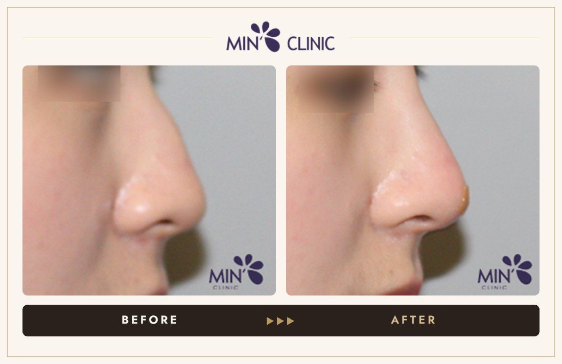 Nose filler before and after, case 47 – MIN Clinic Seoul