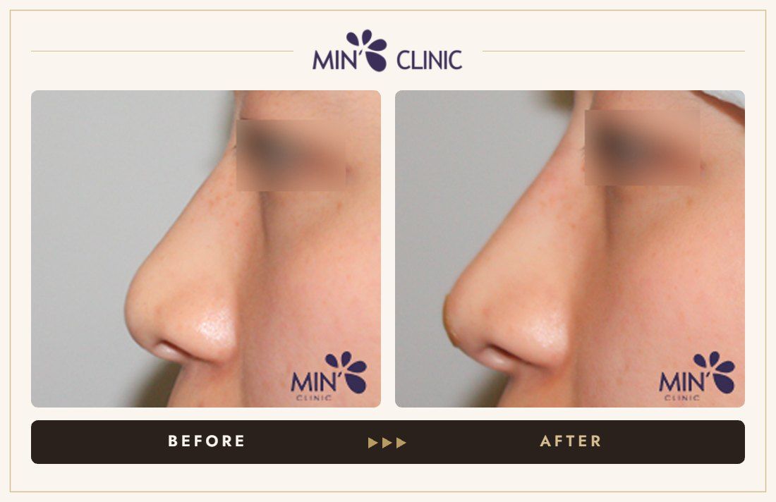 Nose filler before and after, case 49 – MIN Clinic Seoul