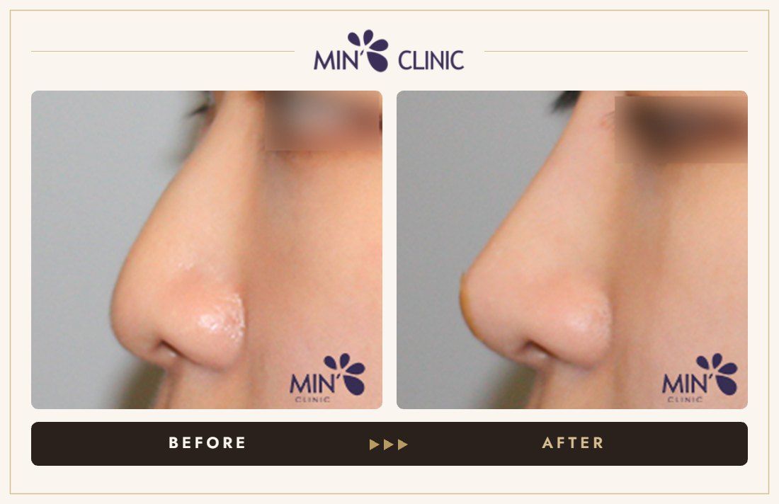 Nose filler before and after, case 50 – MIN Clinic Seoul