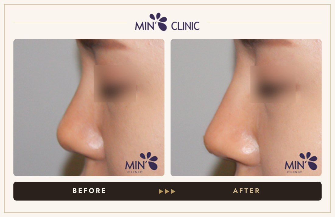 Nose filler before and after, case 51 – MIN Clinic Seoul