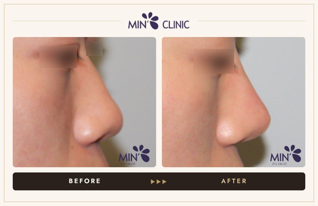Nose filler before and after, case 52 – MIN Clinic Seoul